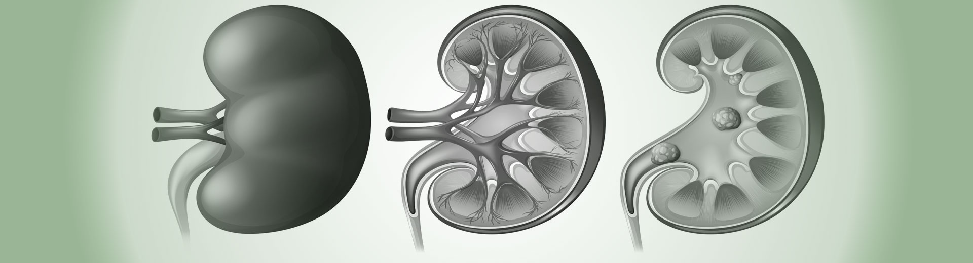 Screening for Kidney Disease and CKD helps prevent CKD through lifestyle education Prevention of CKD and Kidney Disease starts with medical screening by Dr Nonkala